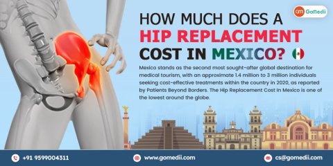 Hip Replacement Cost In Mexico