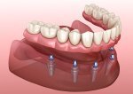 My Dental Implants