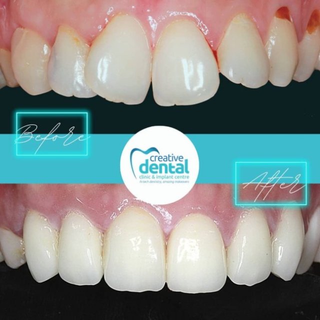 Rediscover your beautiful smile at Creative dental Clinic