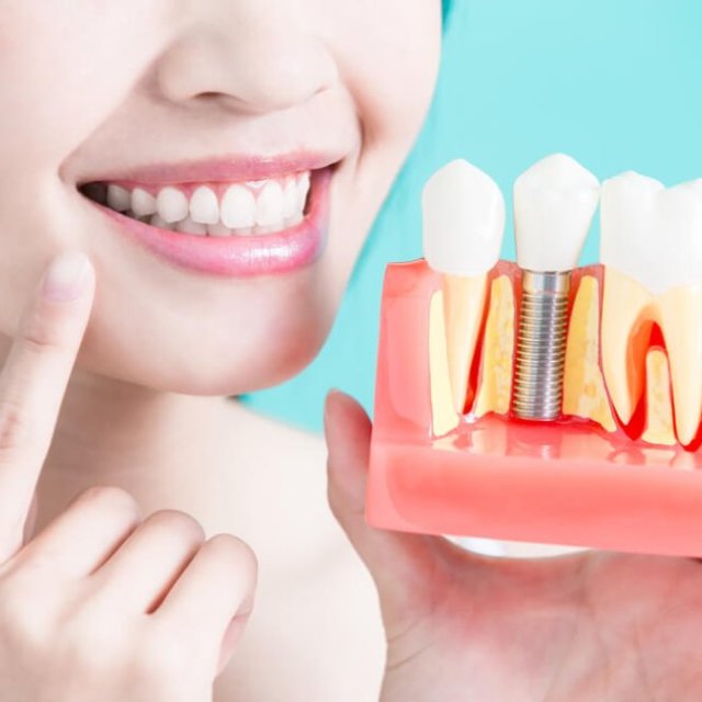 Cost Of Dental Implants in Delhi - Orion Dental Care