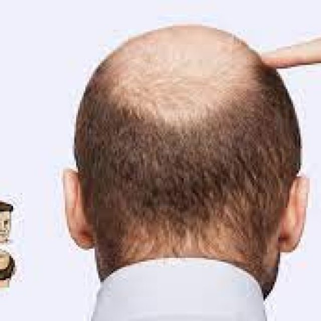 Best hair transplant in India - Dr. A’s Cinic