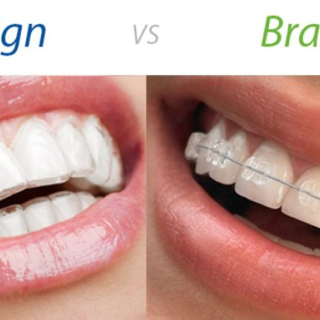 Invisalign Braces in Greater Kailash 1 - orion Dental clinic
