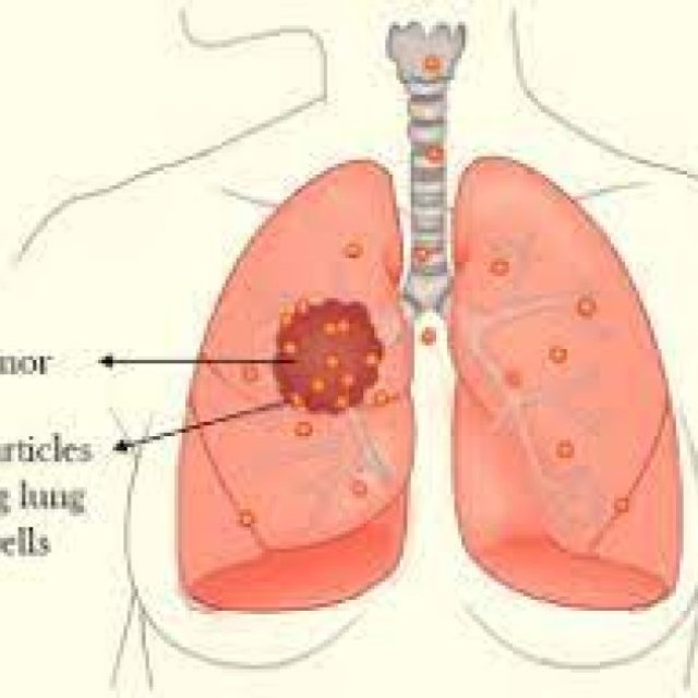 Lung Cancer Treatment Cost in India - Dr. Arvind Kumar