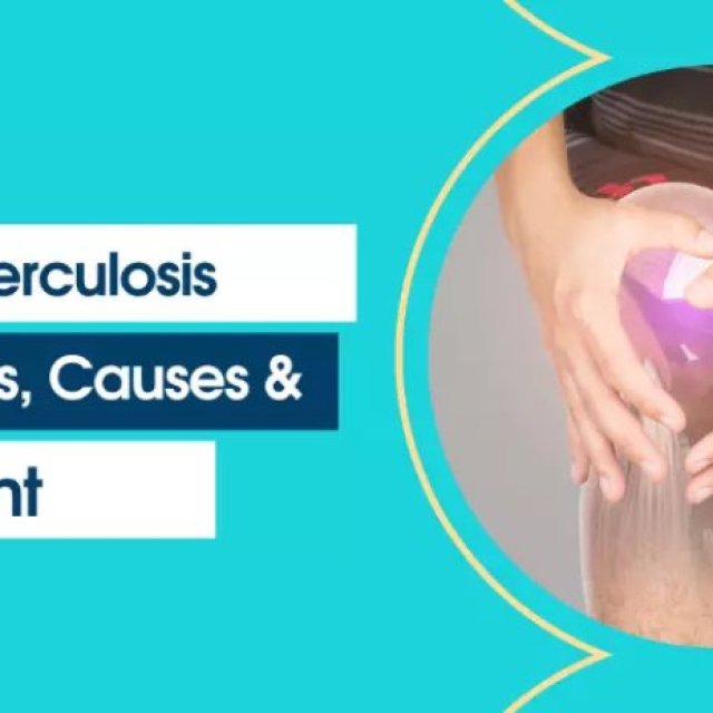 Everything Need to Know About Knee Tuberculosis