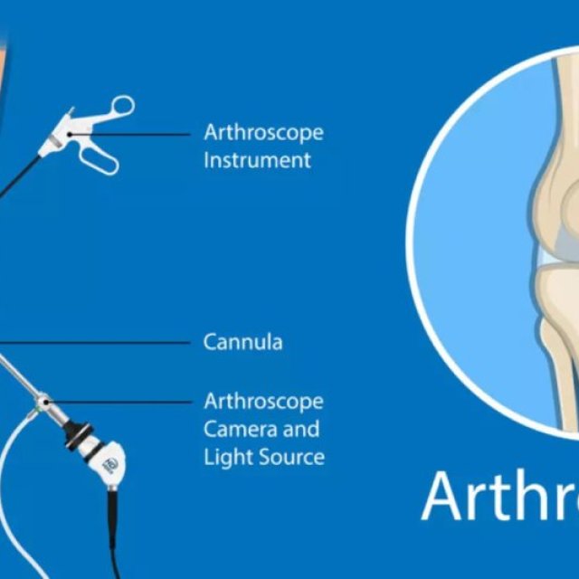 Arthroscopy in Hindi - आर्थोस्कोपी सर्जरी क्या होती हैं?