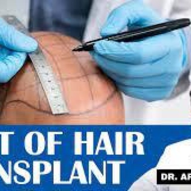 Need to know About Hair Transplant Cost In Delhi