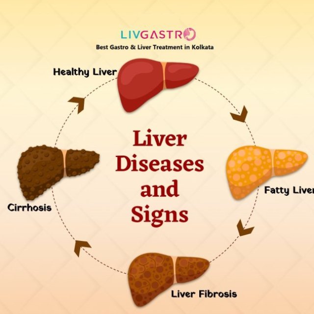 Livgastro - Best Gastro & Liver Treatment in Kolkata