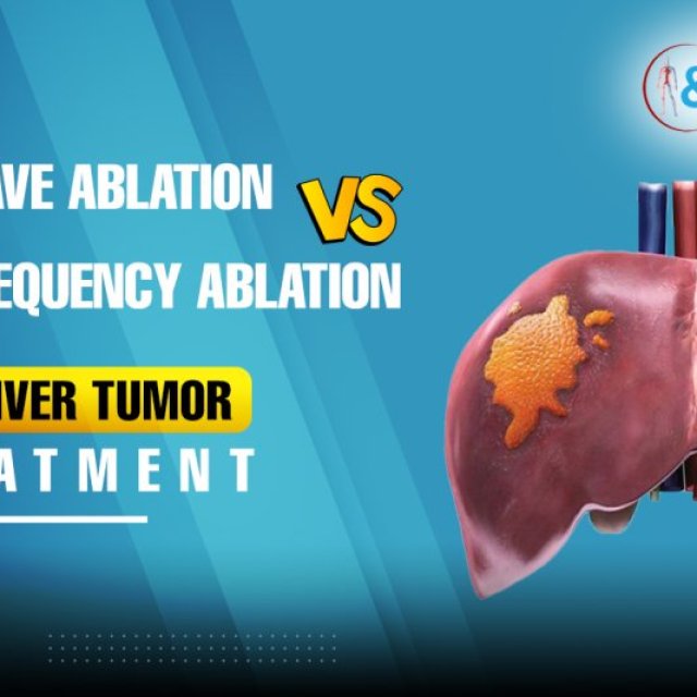 Radiofrequency Ablation Treatments in Hyderabad