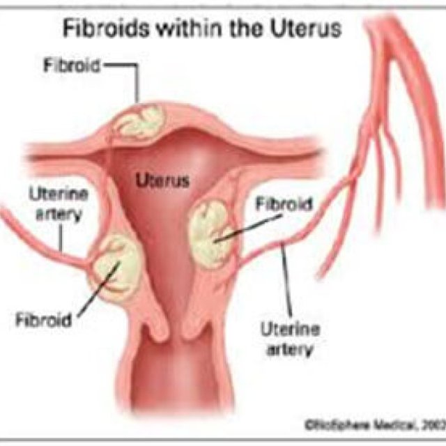 Uterine Fibroid Treatment in Hyderabad | DR. Suresh Giragani