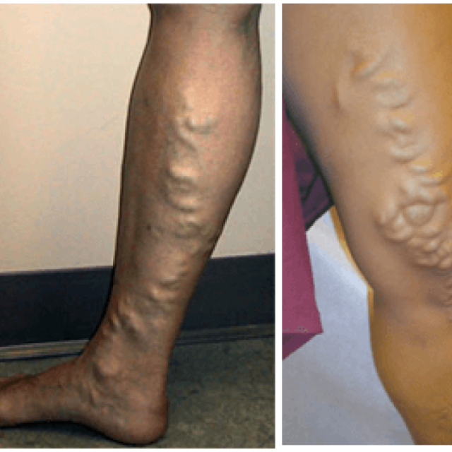 Endovenous Laser Ablation Treatment For Varicose Veins In Hyderabad