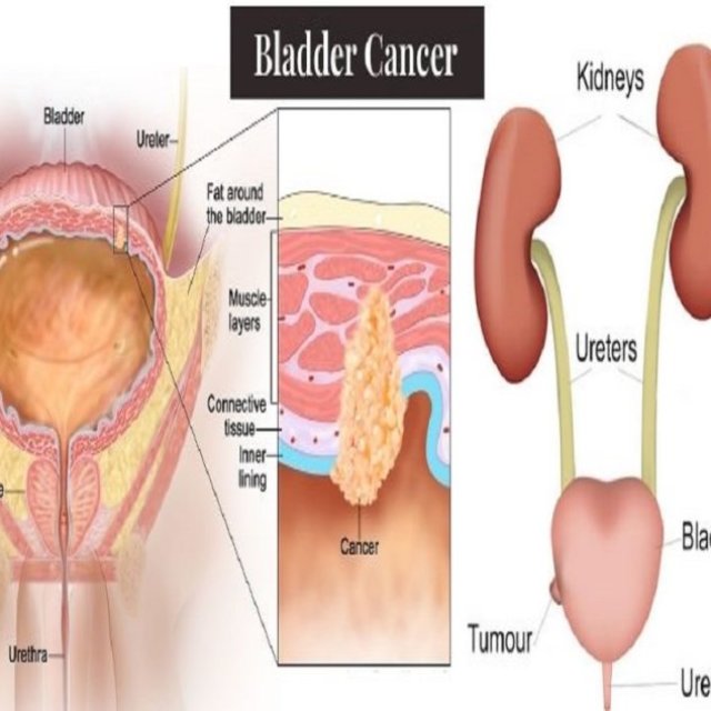 Bladder Cancer Specialist/Surgeon in Navi Mumbai