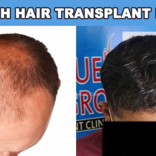 Unique Hair Grow | Hair Transplant Clinic
