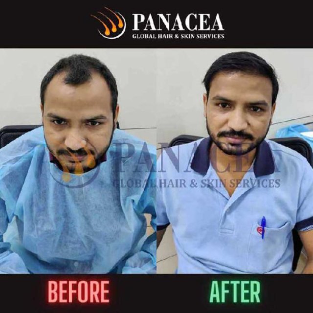 Hair Transplant in Noida