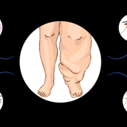 Filariasis : Effective Management | KBK Hospitals