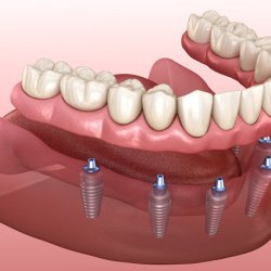 My Dental Implants