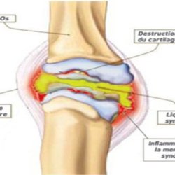 Arthritis Treatment In Pune | Joint Pain Treatment