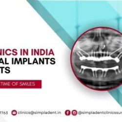 Best Dental Implant Clinic in Surat