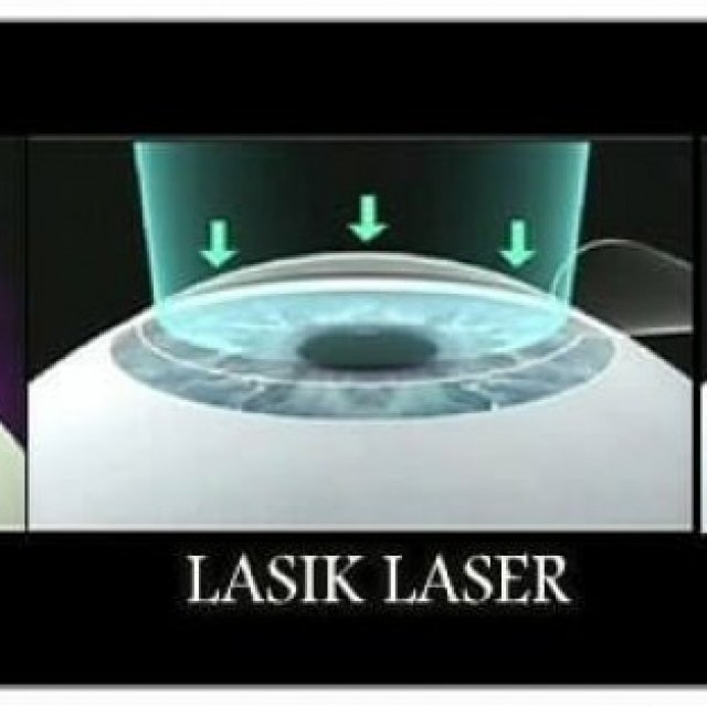 Laser Eye Surgery in The Eye Foundation